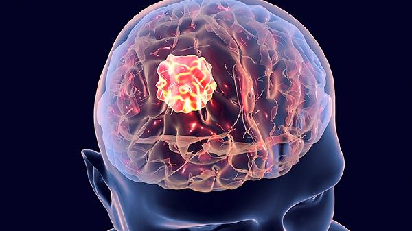 脑溢血发生前会有7个前兆，出现一个以上，需尽早就医