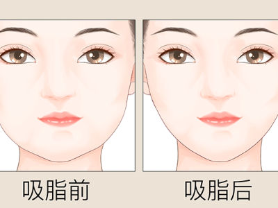 吸脂减肥要多少钱？价格在5000-10000元区间