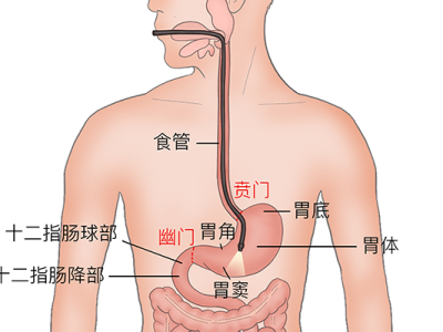 胃套管减肥手术会给你持续的腹泻吗？