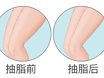 偏方减肥不靠谱，还是选择医学减肥吧