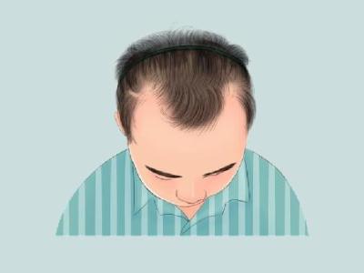 发际线m型怎么解决