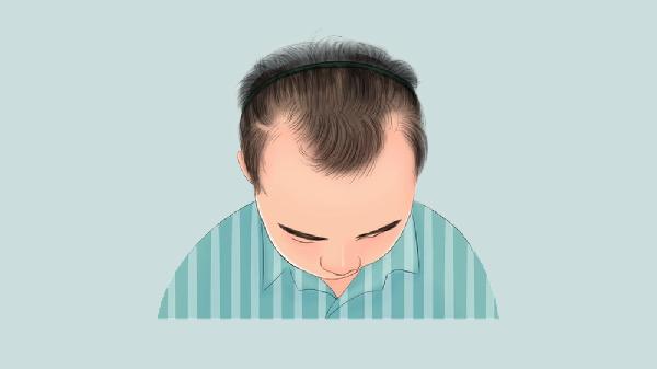 发际线过高应该怎么处理