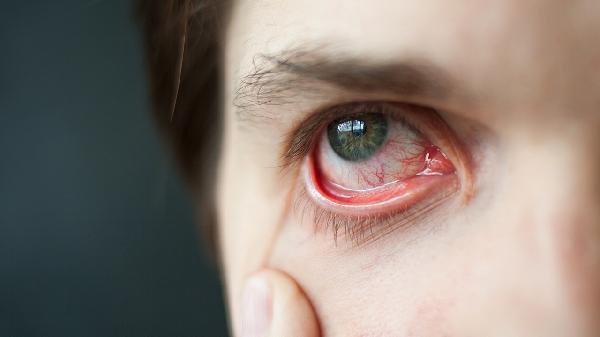 红眼病恢复后视力疲劳能恢复吗