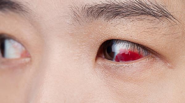 红眼病血跟眼泪一起流出来怎么办-易网<a href=/ target=_blank class=infotextkey>健康养生</a>网 红眼病血跟眼泪一起流出来怎么办