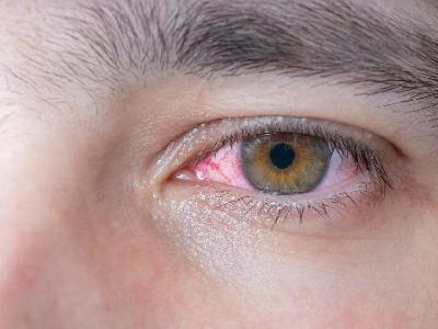 红眼病庆大霉素可以冲洗眼睛吗