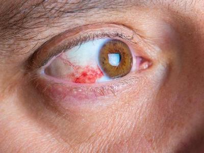 红眼病眼睛模糊是哪些原因导致