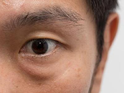 下眼皮肿了眨眼睛就疼是怎么回事