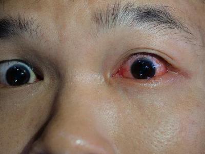 双眼通红是不是就患了红眼病